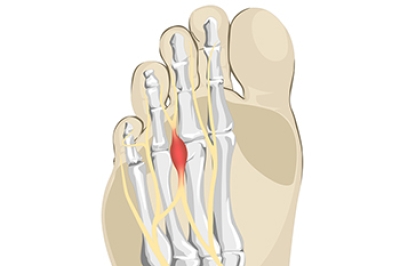 Morton’s Neuroma and Its Symptoms