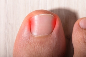 New and Traditional Ways to Treat Ingrown Toenails