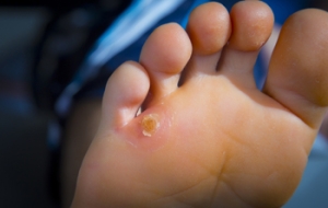 Causes of Corns from Mechanical Hyperkeratosis