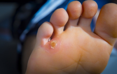 Causes of Corns from Mechanical Hyperkeratosis