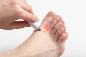 Athlete’s Foot Relief and Prevention Tips